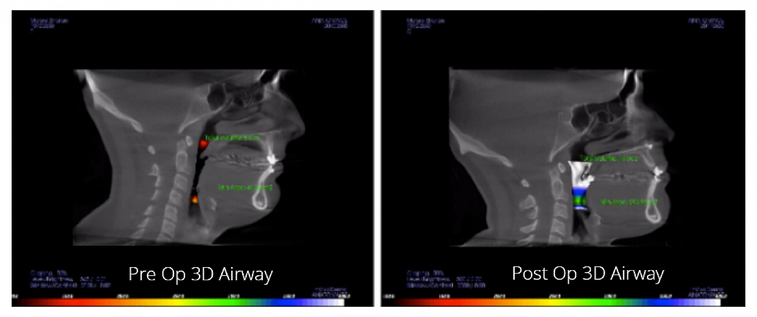 Pre-op and Post-op 3D Airway: Obstructive Sleep Apnea Surgery