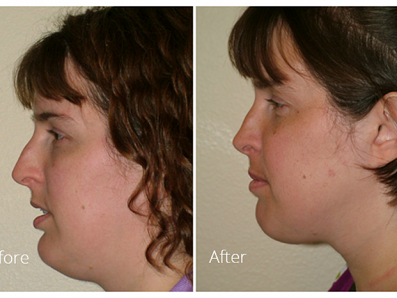 Bimaxillary Advancement Surgery